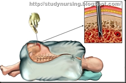 bone marrow monetary gift articles bone marrow monetary gift articles